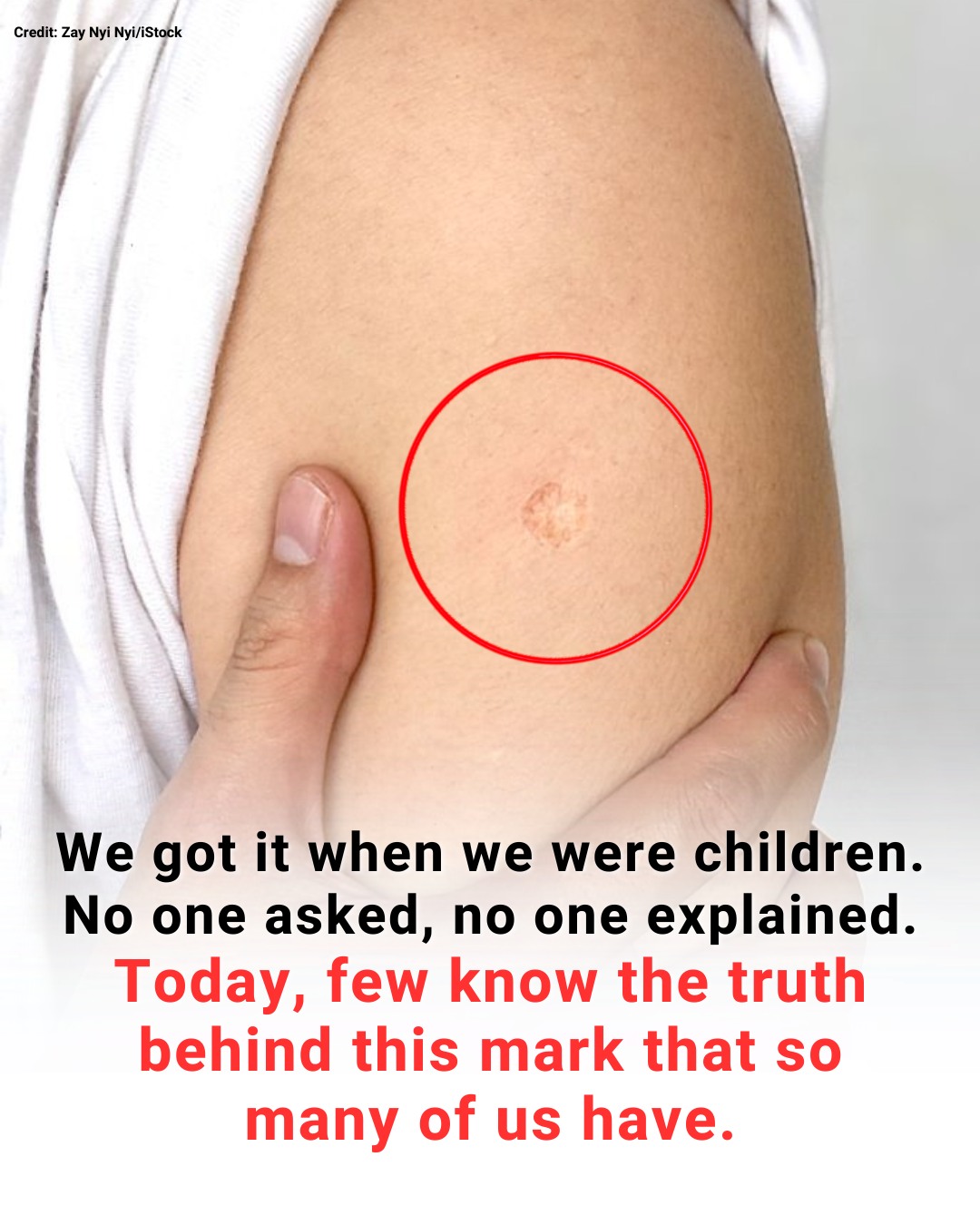 The Truth Behind the Mysterious Round Scar on the Upper Arm